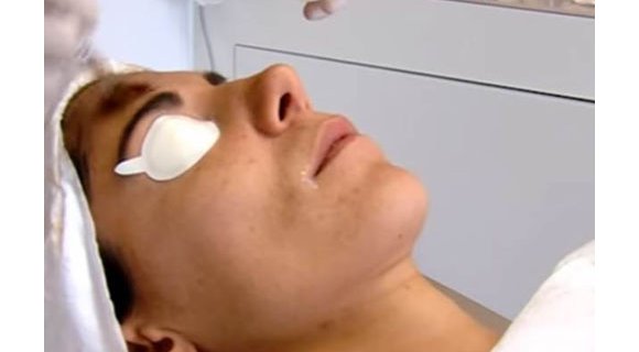 tarifs peeling visage. Dermolaser Toulouse
