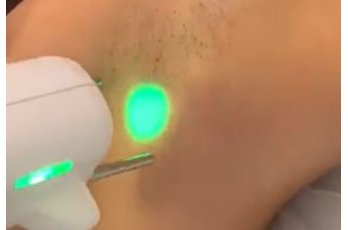 Epilation laser à Toulouse