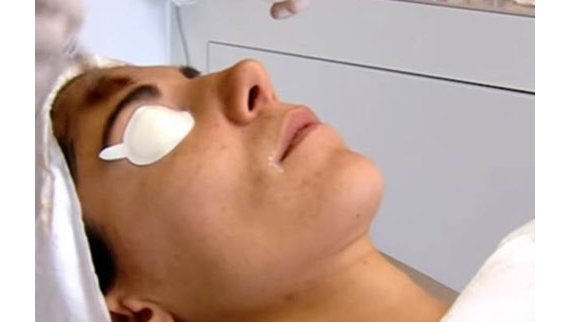 Tarifs peeling