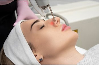 Laser vasculaire Nd-YAG à Toulouse