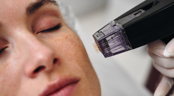 soin de radiofréquence microneedling sur visage jeune femme. Dermolaser Toulouse